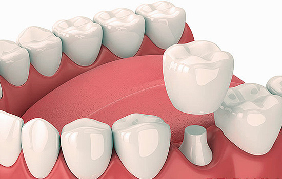 Crowns & Bridges — representative treatment image