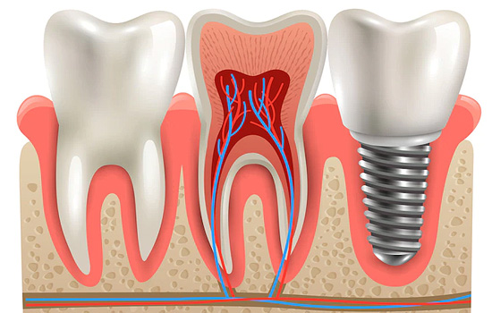Dental Implants — representative treatment image
